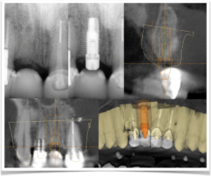 Digital Workflow For Implant Dentistry at North Shore Implant & Oral Surgery Associates