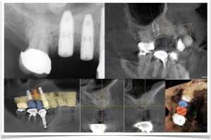 Dental Implant Surgery at North Shore Implant & Oral Surgery Associates
